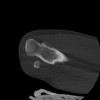 SPORK, NICO - 22.03.1976 - 02.08.2022 - CT obere Extremität - 17:59:38